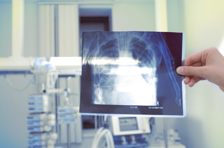 Xray of silicosis diagnosis